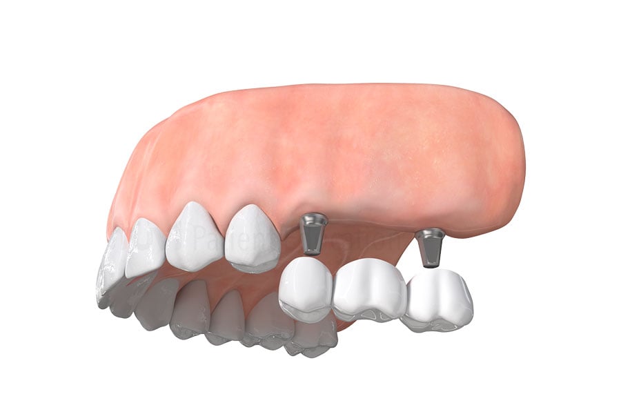 Dental Implant Bridge in Austin, TX