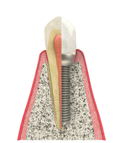 Benefits of Dental Implants in Austin, TX