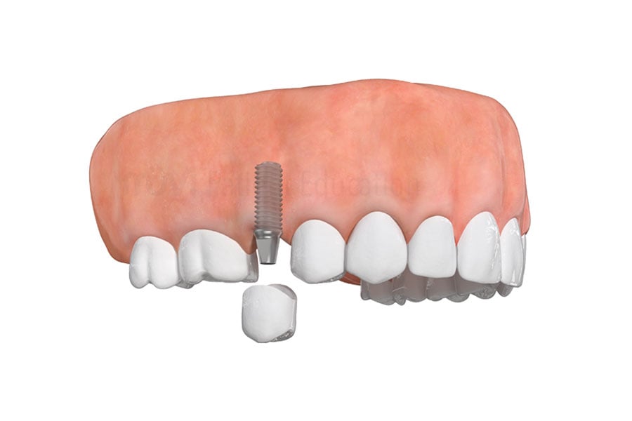 Dental Implants in Austin, TX