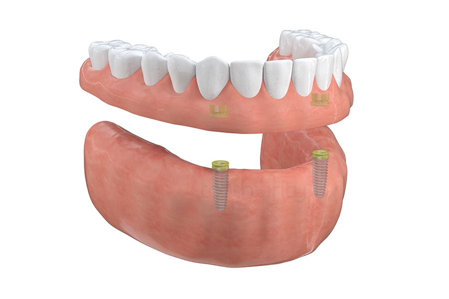 Implant-Supported Overdentures in Austin, TX