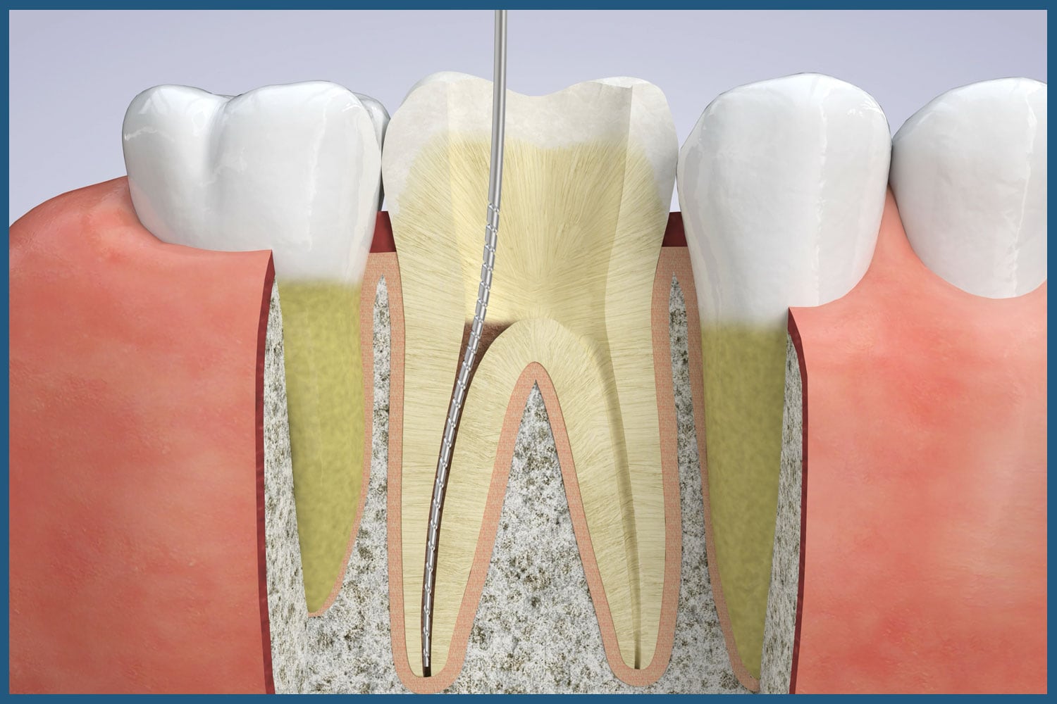 Stages of Root Canal Therapy in Austin, TX