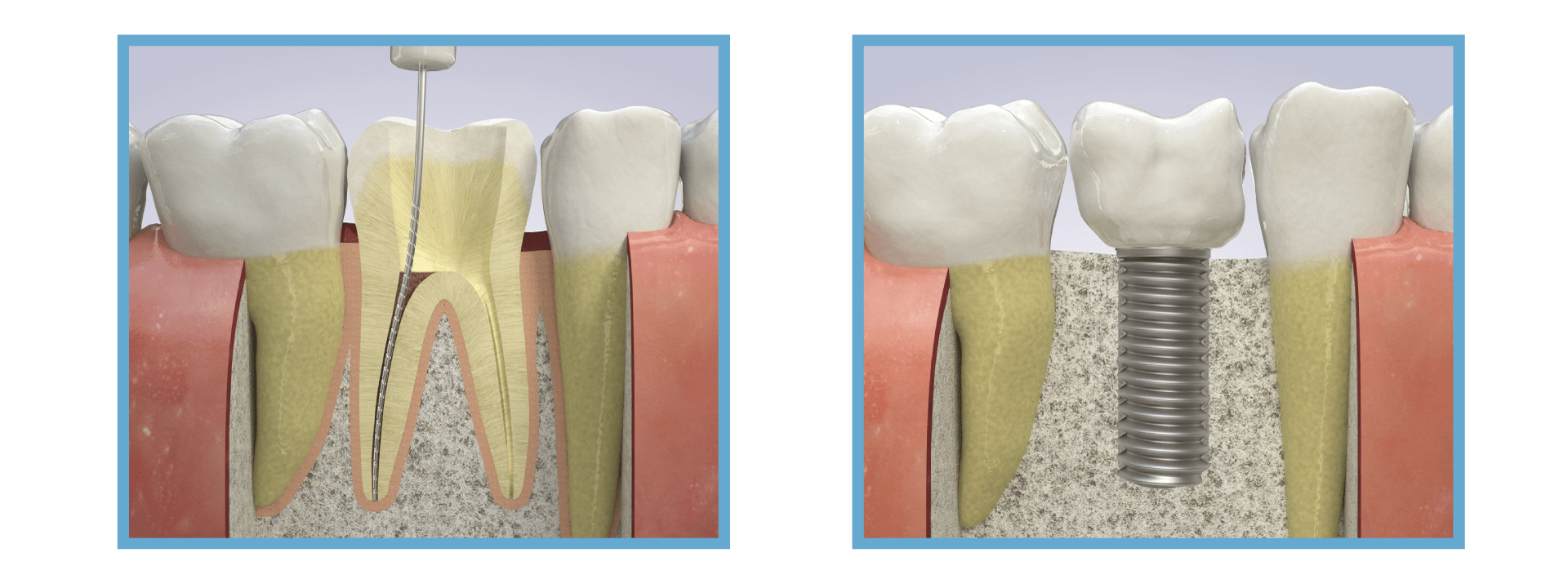 Image of dental implant vs root canal