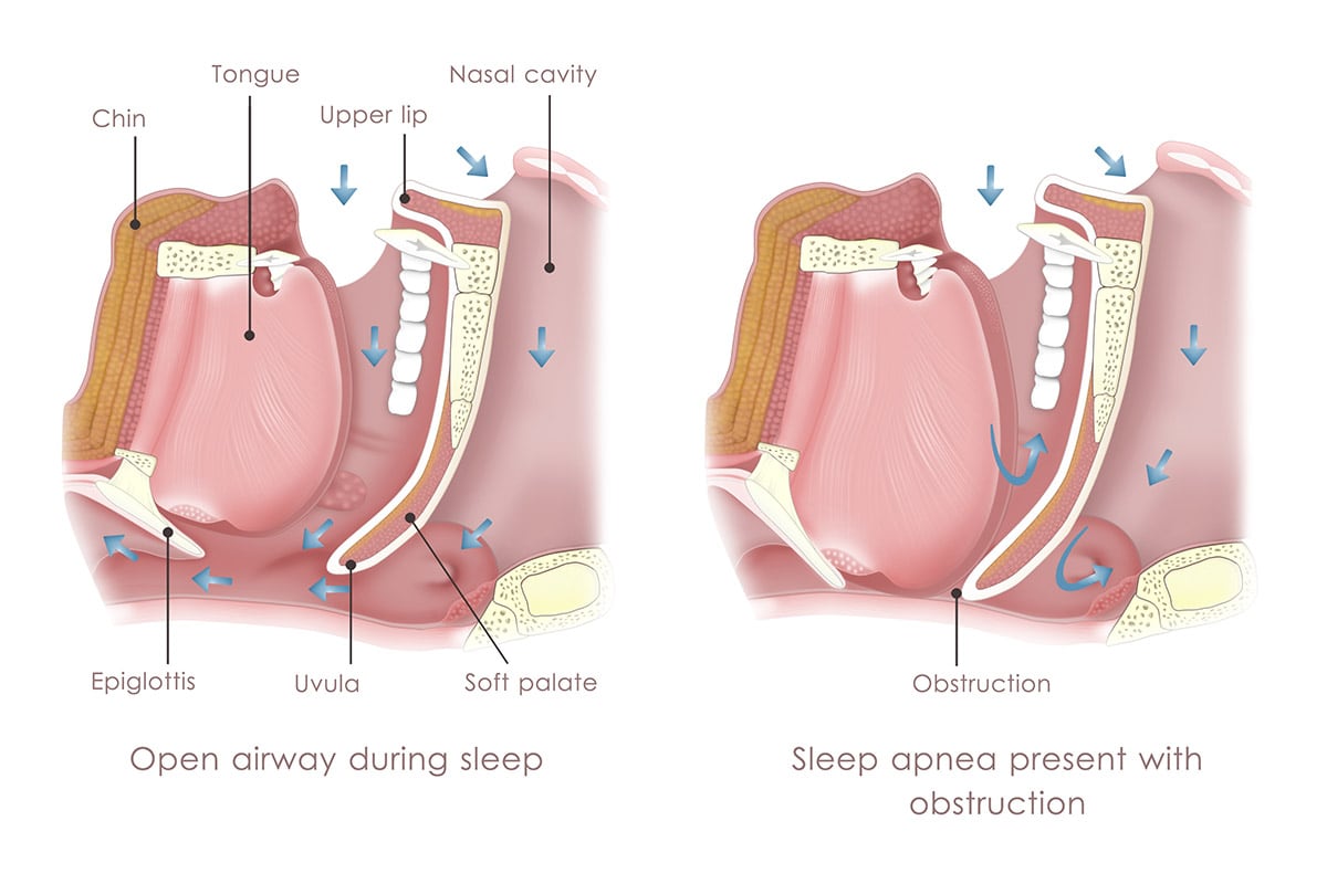 Sleep Apnea in Austin, TX